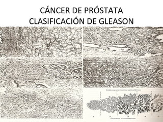 CÁNCER DE PRÓSTATA
CLASIFICACIÓN DE GLEASON
 