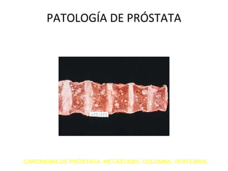 PATOLOGÍA DE PRÓSTATA
CARCINOMA DE PRÓSTATA. METÁSTASIS COLUMNA VERTEBRAL
 