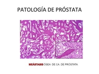 PATOLOGÍA DE PRÓSTATA
 