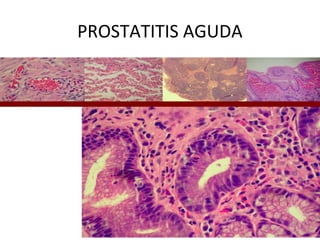 PROSTATITIS AGUDA
 