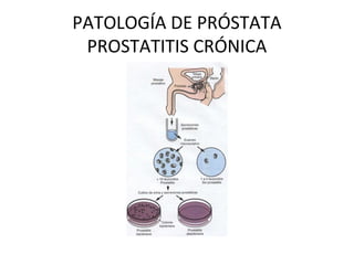 PATOLOGÍA DE PRÓSTATA
PROSTATITIS CRÓNICA
 