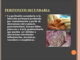 PERITONITIS SECUNDARIA La peritonitis secundaria es la infección peritoneal producida por contaminación a partir de alteraciones del conducto gastrointestinal, sistema biliar, páncreas y tracto genitourinario que pueden  ser debidas a alteraciones intestinales inflamatorias, mecánicas, vasculares o neoplásicas. 
