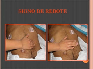 SIGNO DE REBOTE
 