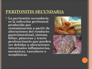 PERITONITIS SECUNDARIA
 La peritonitis secundaria
es la infección peritoneal
producida por
contaminación a partir de
alteraciones del conducto
gastrointestinal, sistema
biliar, páncreas y tracto
genitourinario que pueden
ser debidas a alteraciones
intestinales inflamatorias,
mecánicas, vasculares o
neoplásicas.
 