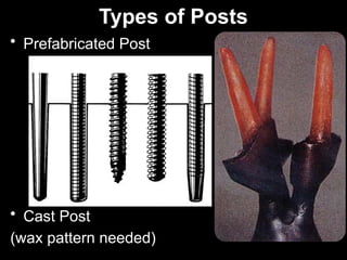 1 Post and core-1 (Muhadharaty)rrrr.pptx