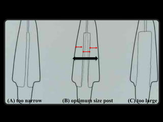 1 Post and core-1 (Muhadharaty)rrrr.pptx