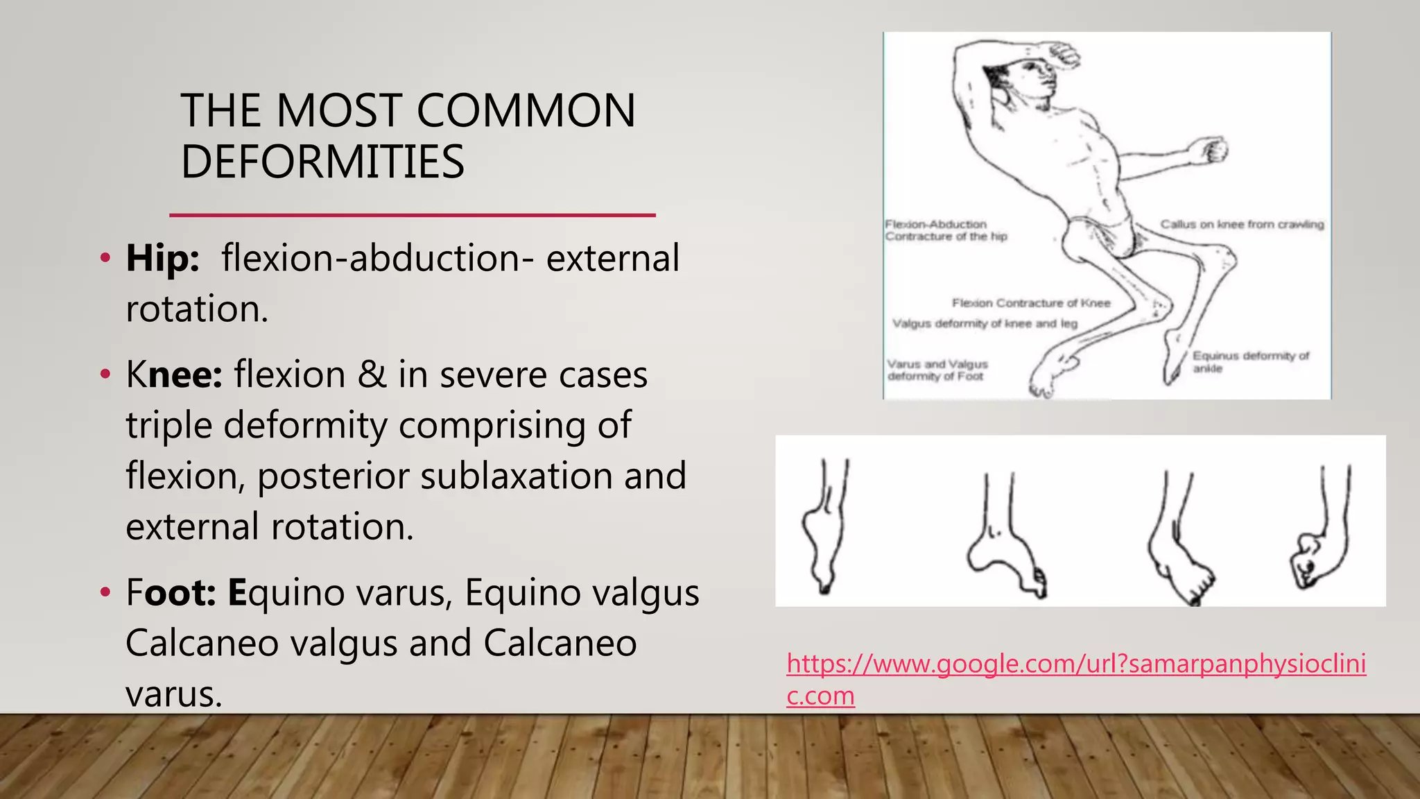 Post Polio Residual Palsy: Pathophysiology & Principles of Rx | PPTX