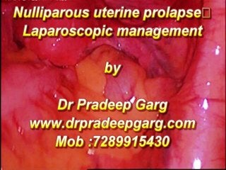 Nulliparous Uterine Prolapse Laparoscopic Management, Mob :7289915430, www.drpradeepgarg.com