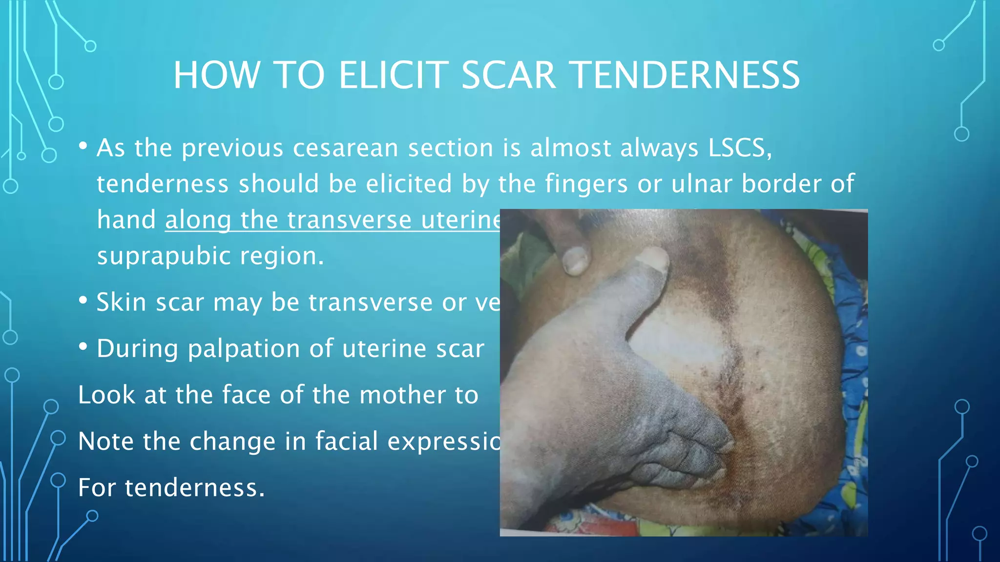 Pregnancy with previous cesarean section | PPTX
