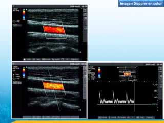 Imagen Doppler en color
 