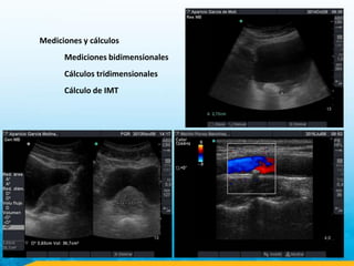 Mediciones y cálculos
Mediciones bidimensionales
Cálculos tridimensionales
Cálculo de IMT
 