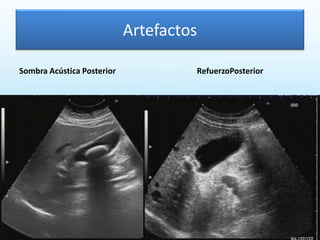 Artefactos
Sombra Acústica Posterior RefuerzoPosterior
 