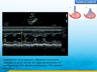 Trazado en modo M
Cuantificación de los espesores y diámetros ventriculares
izquierdos en un eco normal. SIV: septo interventricular; PP:
pared posterior; DTD: diámetro telediastólico; DTS: diámetro
telesistólico.
 