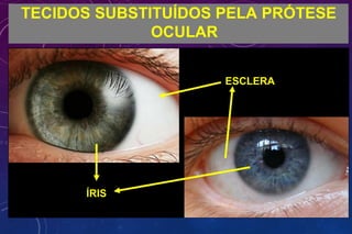 TECIDOS SUBSTITUÍDOS PELA PRÓTESE
OCULAR
ESCLERA
ÍRIS
 