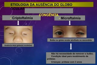ETIOLOGIA DA AUSÊNCIA DO GLOBO
OCULAR
CONGÊNITA
- Criptoftalmia
Ausência do(s) globo(s) ocular(es)
- Microftalmia
Bulbo ou globo ocular atrofiado ou escondido
- Não há necessidade de remover o bulbo;
- Condição ideal para recebimento de
prótese;
- Crianças: prótese com 3 anos
 