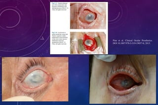 Pine et al. Clinical Ocular Prosthetics.
DOI 10.1007/978-3-319-19057-0, 2015.
 