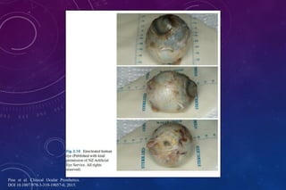 Pine et al. Clinical Ocular Prosthetics.
DOI 10.1007/978-3-319-19057-0, 2015.
 