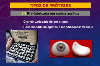 TIPOS DE PRÓTESES
2°) Pré-fabricada em resina acrílica
- Grande variedade de cor e tipo;
- Possibilidade de ajustes e modificações: fresas e
lixas
 