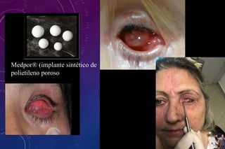 Medpor® (implante sintético de
polietileno poroso
 