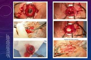 Implante de hidroxiapatita
Pine
et
al.
Clinical
Ocular
Prosthetics.
DOI
10.1007/978-3-319-19057-0,
2015.
Pine
et
al.
Clinical
Ocular
Prosthetics.
DOI
10.1007/978-3-319-19057-0,
2015.
 