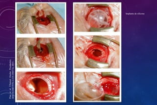 Implante de silicone
Pine
et
al.
Clinical
Ocular
Prosthetics.
DOI
10.1007/978-3-319-19057-0,
2015.
 