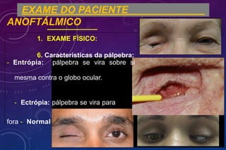 EXAME DO PACIENTE
ANOFTÁLMICO
1. EXAME FÍSICO:
6. Características da pálpebra:
- Entrópia: pálpebra se vira sobre si
mesma contra o globo ocular.
- Ectrópia: pálpebra se vira para
fora - Normal
 