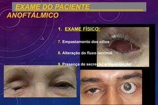 EXAME DO PACIENTE
ANOFTÁLMICO
1. EXAME FÍSICO:
7. Empastamento dos cílios
8. Alteração do fluxo lacrimal
9. Presença de secreção e higienização
FORP - USP
 