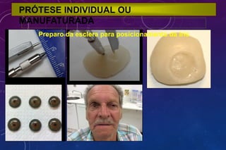 PRÓTESE INDIVIDUAL OU
MANUFATURADA
Preparo da esclera para posicionamento da íris
 