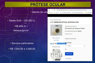 PRÓTESE OCULAR
• Valores de uma prótese ocular
• Tabela SUS – CID:Z97.0
• R$ 458,31 –
datasus.gov.br
• Serviços particulares
• R$ 1.000,00 a 3.000,00
 