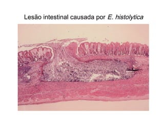 Lesão intestinal causada por E. histolytica
 