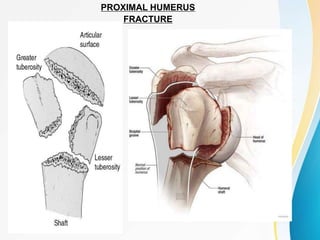 PROXIMAL
HUMERUS
FRACTURES
PROXIMAL HUMERUS
FRACTURE
 