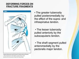 DEFORMING FORCES ON
FRACTURE FRAGMENTS
• The greater tuberosity
pulled posteromedially by
the effect of the supra- and
infraspinatus tendon.
• The lesser tuberosity
pulled anteriorly by the
subscapularis tendon.
• The shaft segment pulled
anteromedially by the
pectoralis major tendon.
 