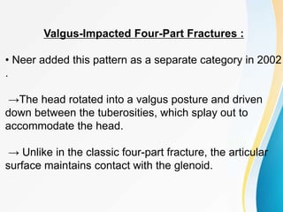 Valgus-Impacted Four-Part Fractures :
• Neer added this pattern as a separate category in 2002
.
→The head rotated into a valgus posture and driven
down between the tuberosities, which splay out to
accommodate the head.
→ Unlike in the classic four-part fracture, the articular
surface maintains contact with the glenoid.
 