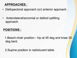 APPROACHES :
• Deltopectoral approach (or) anterior approach .
• Anterolateral/acromial or deltoid splitting
approach.
POSITIONS :
1.Beach-chair position - hip at 45 deg and knee 30
deg bent.
2.Supine position in radiolucent table.
 
