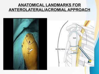 ANATOMICAL LANDMARKS FOR
ANTEROLATERAL/ACROMIAL APPROACH
 