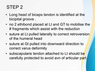 STEP 2
• Long head of biceps tendon is identified at the
bicipital groove .
• no 2 ethibond placed at Lt and GT to mobilise the
# fragments which assist with the reduction
• suture at Lt pulled laterally to correct retroversion
of the humeral head
• suture at Gt pulled into downward direction to
correct varus deformity
• subscapularis tendon attached to Lt should be
carefully protected to avoid avn of articular part.
 