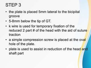 STEP 3
• the plate is placed 5mm lateral to the bicipital
groove
• 5-8mm below the tip of GT.
• k wire is used for temporary fixation of the
reduced 2 part # of the head with the aid of suture
traction
• a simple compression screw is placed at the oval
hole of the plate.
• plate is used to assist in reduction of the head and
shaft part
 
