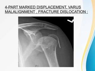 4-PART MARKED DISPLACEMENT, VARUS
MALALIGNMENT , FRACTURE DISLOCATION :
 