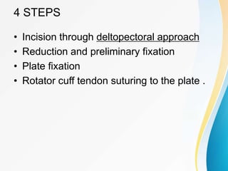 4 STEPS
• Incision through deltopectoral approach
• Reduction and preliminary fixation
• Plate fixation
• Rotator cuff tendon suturing to the plate .
 
