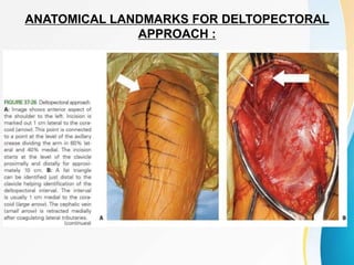 ANATOMICAL LANDMARKS FOR DELTOPECTORAL
APPROACH :
 