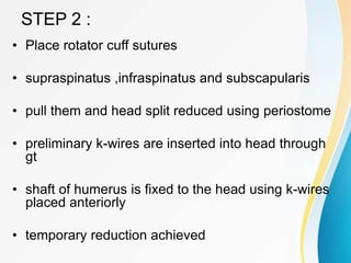 STEP 2 :
• Place rotator cuff sutures
• supraspinatus ,infraspinatus and subscapularis
• pull them and head split reduced using periostome
• preliminary k-wires are inserted into head through
gt
• shaft of humerus is fixed to the head using k-wires
placed anteriorly
• temporary reduction achieved
 
