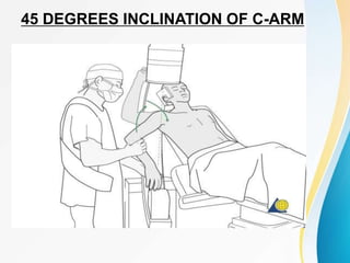 45 DEGREES INCLINATION OF C-ARM
 