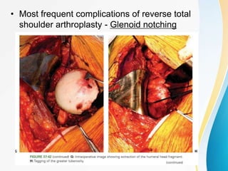 • Most frequent complications of reverse total
shoulder arthroplasty - Glenoid notching
 