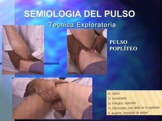 Tecnica ExploratoriaTecnica Exploratoria
SEMIOLOGIA DEL PULSO
PULSO
POPLÍTEO
 