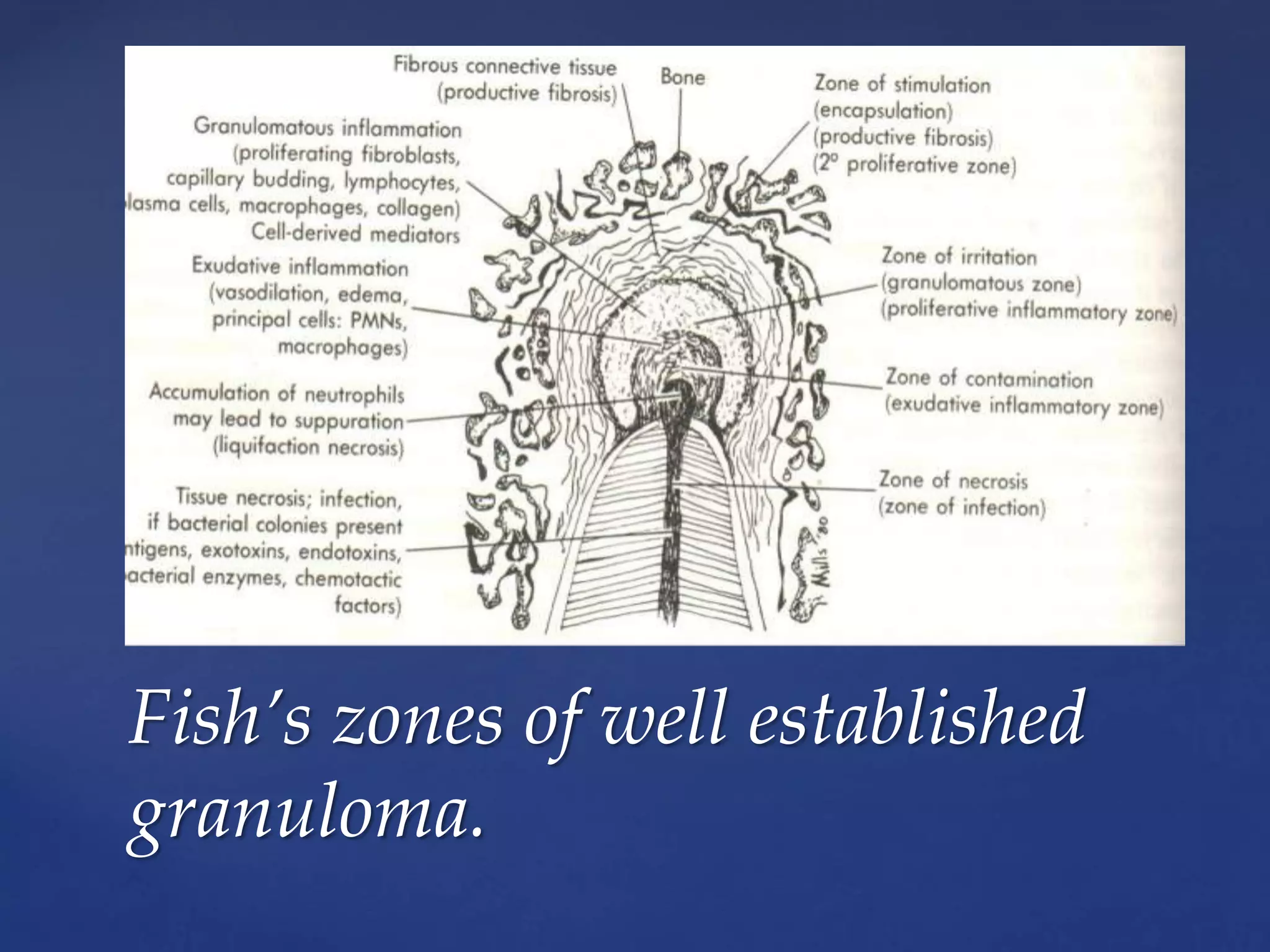 Fish’s zones of well established
granuloma.
 