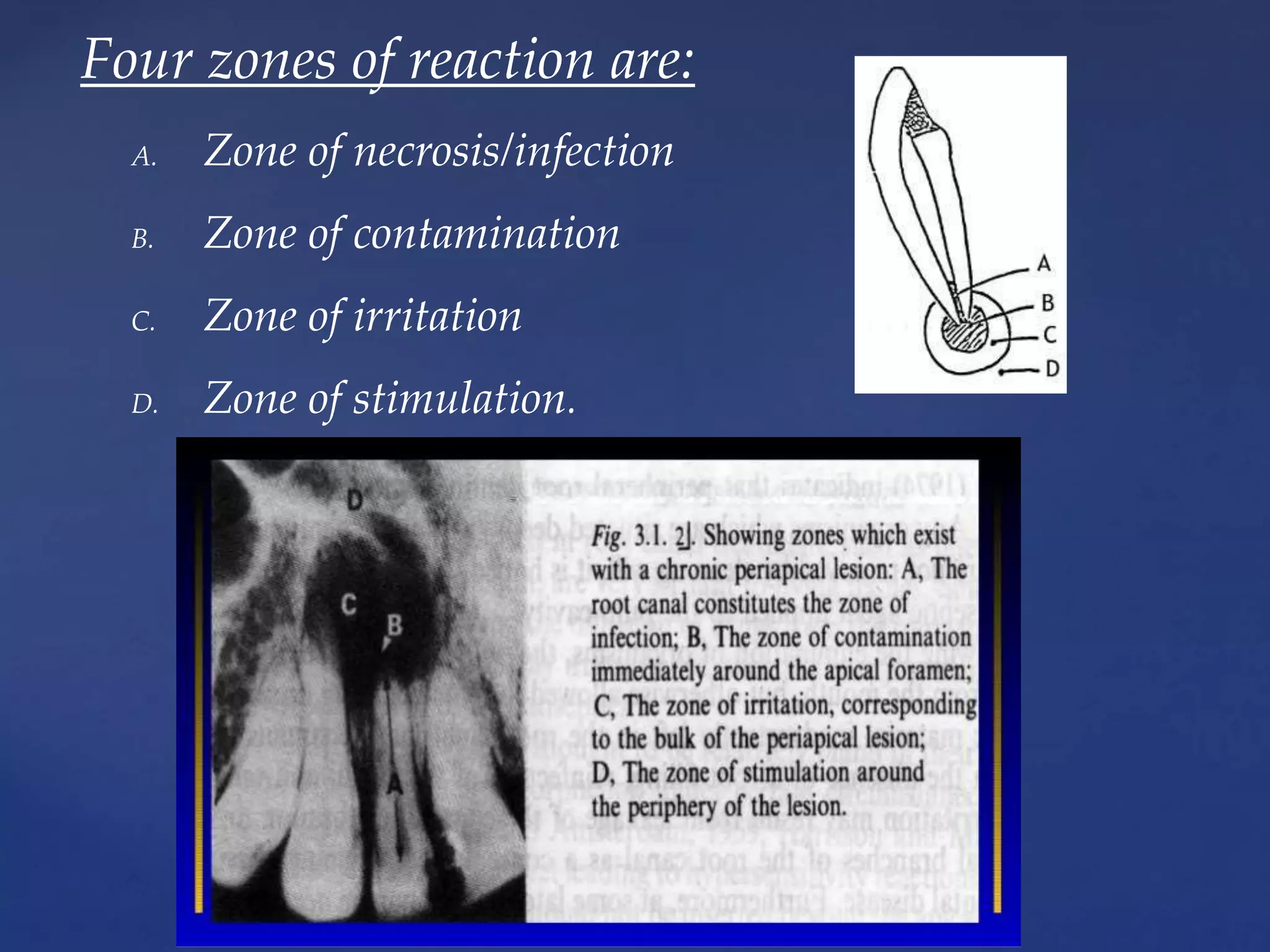 Four zones of reaction are:
A. Zone of necrosis/infection
B. Zone of contamination
C. Zone of irritation
D. Zone of stimulation.
 