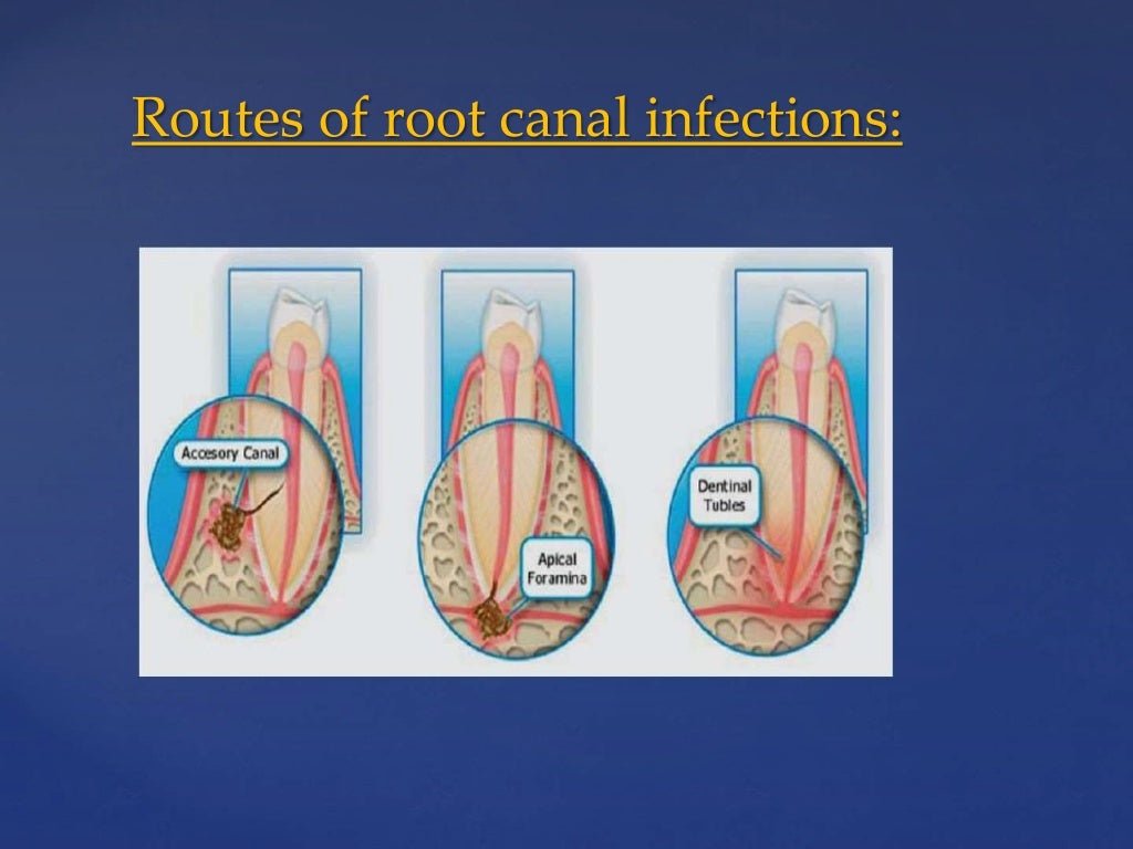 Rationale of endodontics
