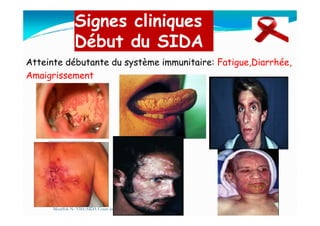 Signes cliniques
Début du SIDA
Atteinte débutante du système immunitaire: Fatigue,Diarrhée,
Amaigrissement
Mouffok N- VIH/SIDA Cours nov 2013
 