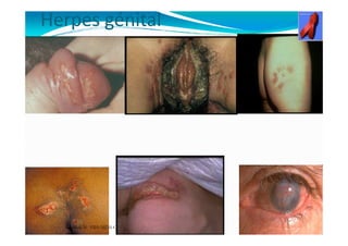 Herpes génital
Mouffok NMouffok NMouffok N- VIH/SIDA Cours nov 2013
 