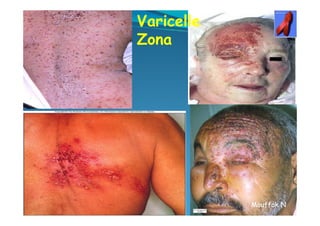 VaricelleVaricelle
ZonaZona
Mouffok NMouffok N
 